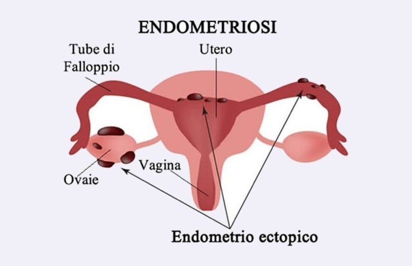 endometriosi-sintomi