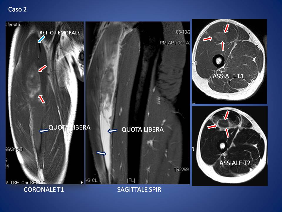 lesione-muscolare-calcio-risonanza-magnetica