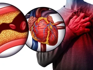 colesterolo-ictus-infarto