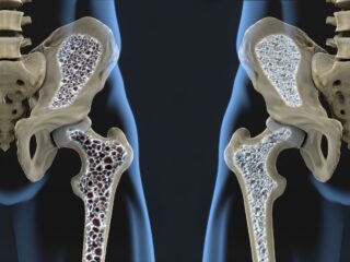 osteporosi