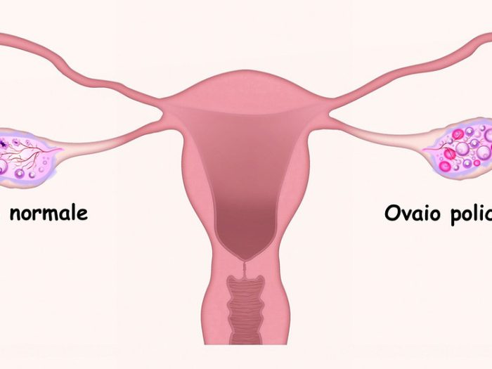 sindrome-ovaio-policistico-sintomi-terapie
